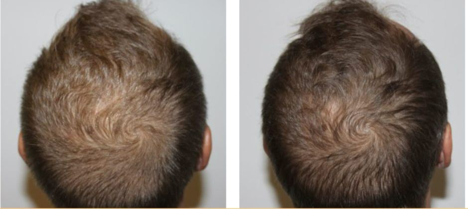Hair Rejuvenation before and after 1