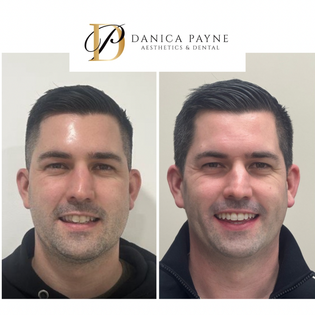 Invisalign Male Patient — Before & After