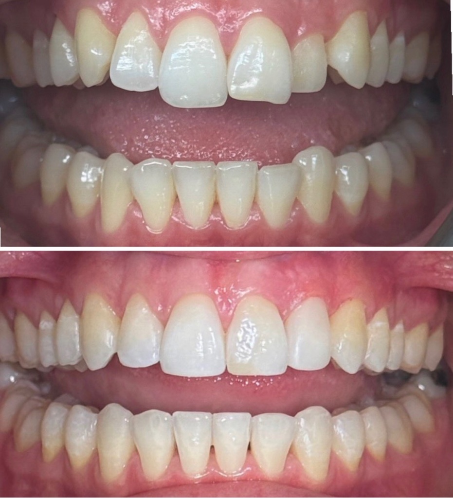 Invisalign before and after transformation 1