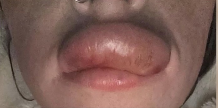 Lip Inflammation — Emergency