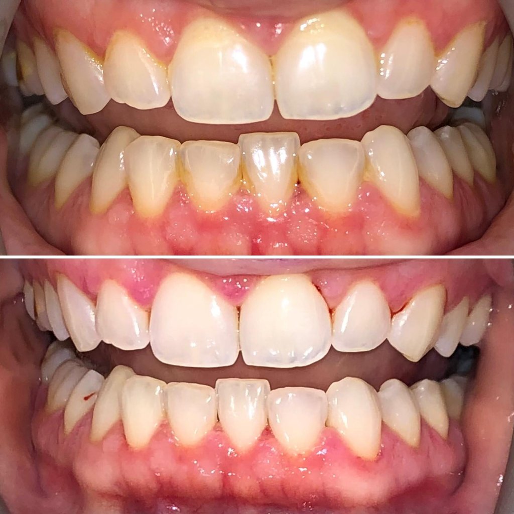 Dental Cleaning & Whitening — Before & After