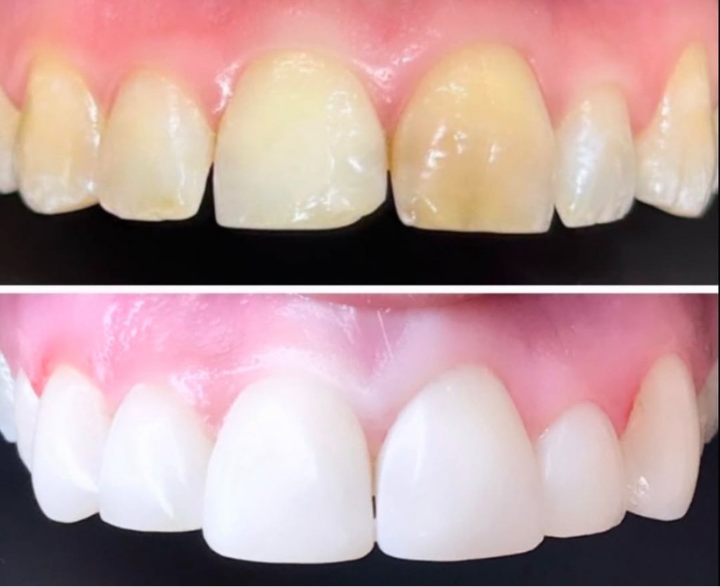 Professional Teeth Whitening — Before & After