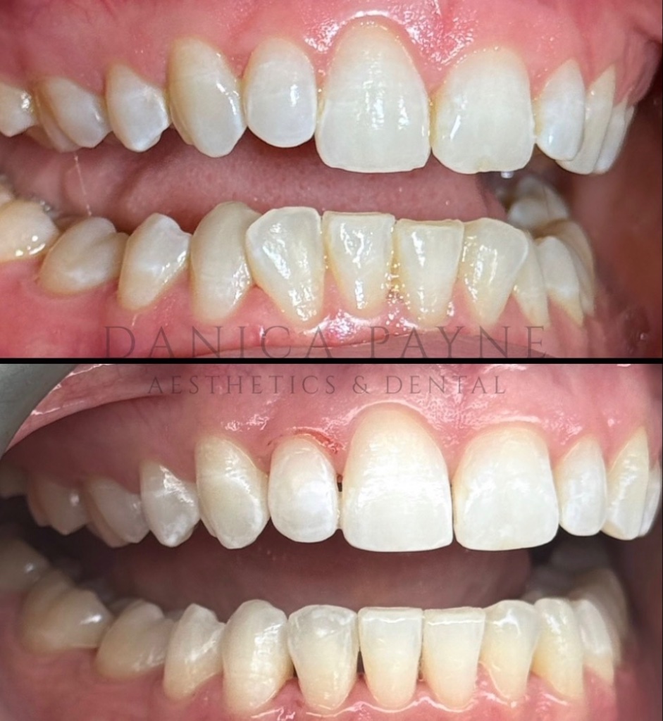 Invisalign before and after transformation 7