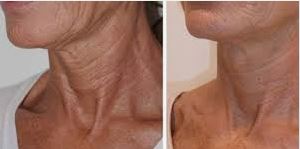Neck Biorejuvenation — Before & After