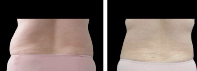 Love Handles Fat Freezing — Before & After
