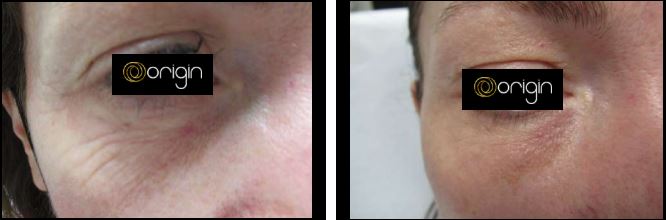 Glass Laser Eye Rejuvenation — Before & After