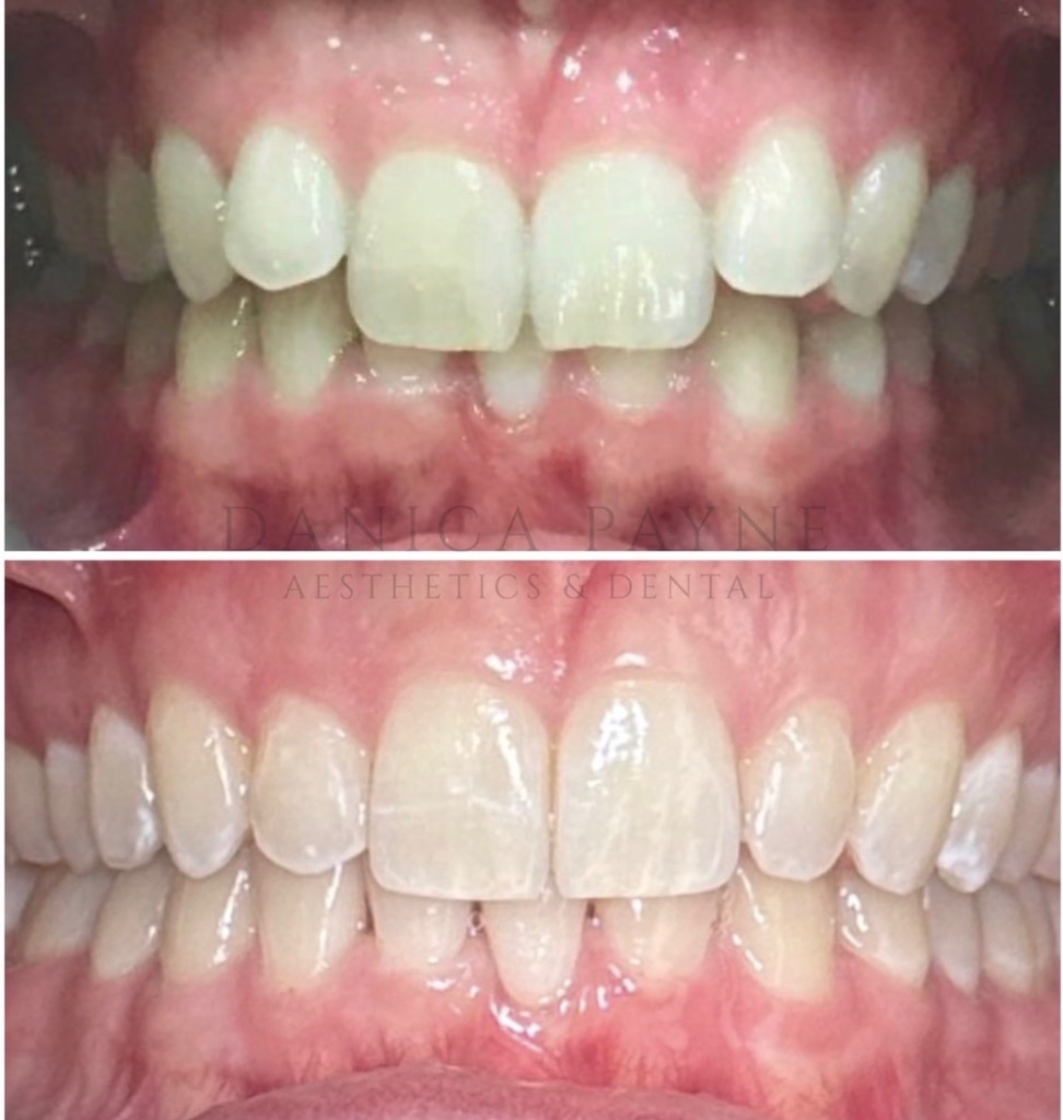 Invisalign before and after transformation 4
