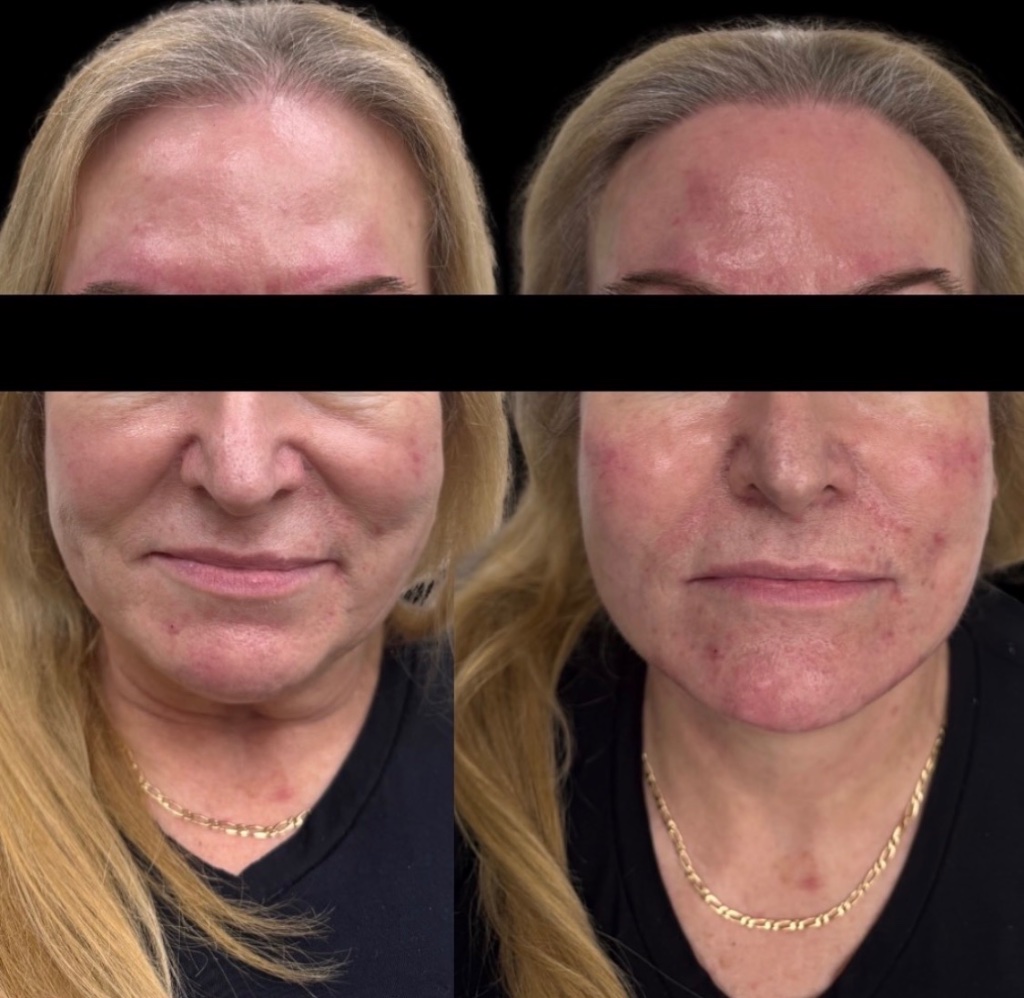 Injectables gallery 6