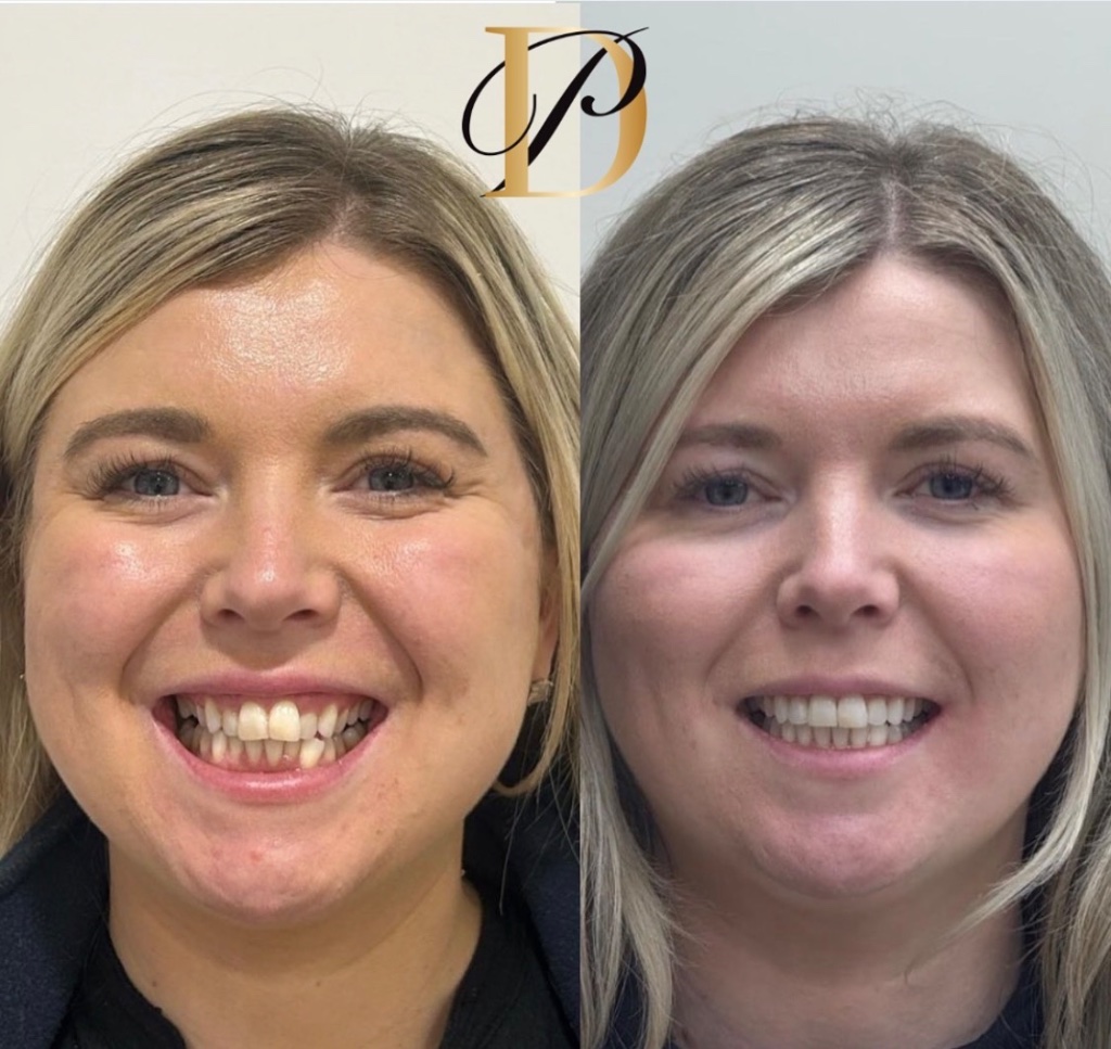 Invisalign smile transformation 3