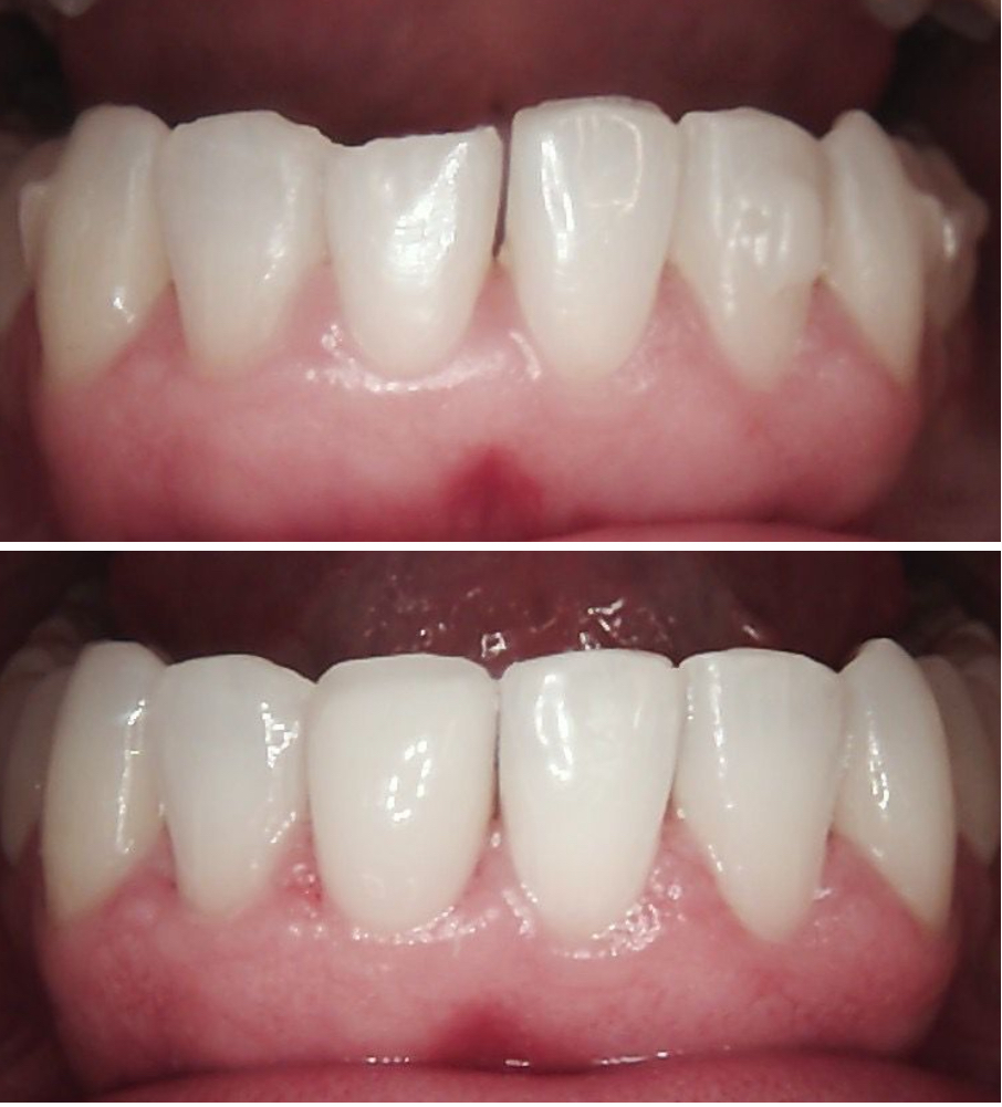 Dental Alignment — Before & After