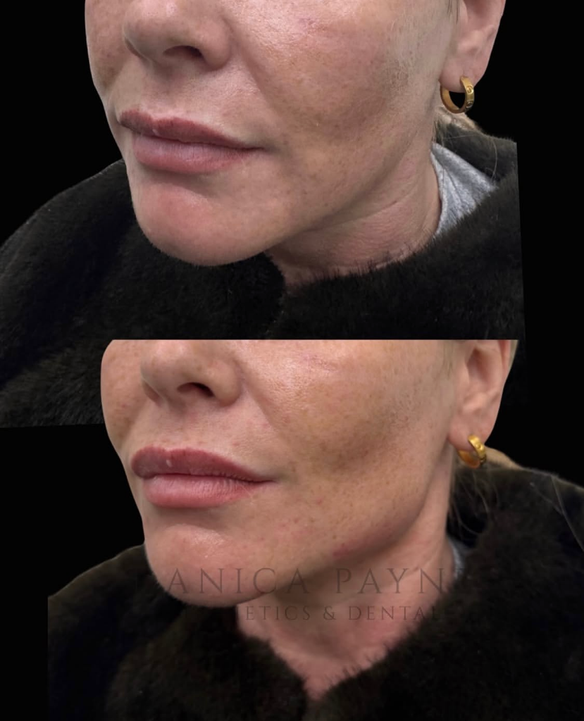 Jaw & Chin Filler — Before & After
