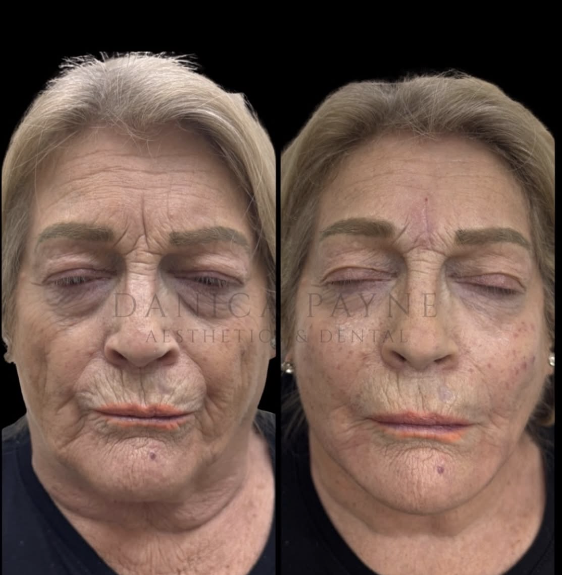 Full Face Rejuvenation — Before & After