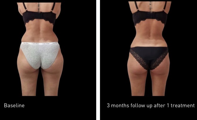 Hips and glutes fat freezing before and after — baseline vs 3 months follow up after 1 treatment