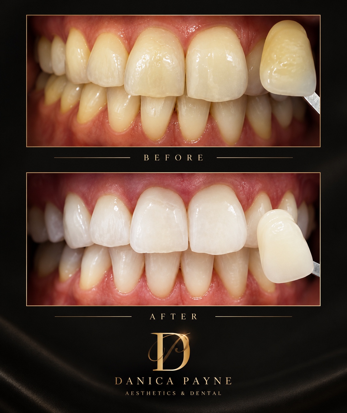 Before and after tooth whitening treatment at Danica Payne Aesthetics & Dental
