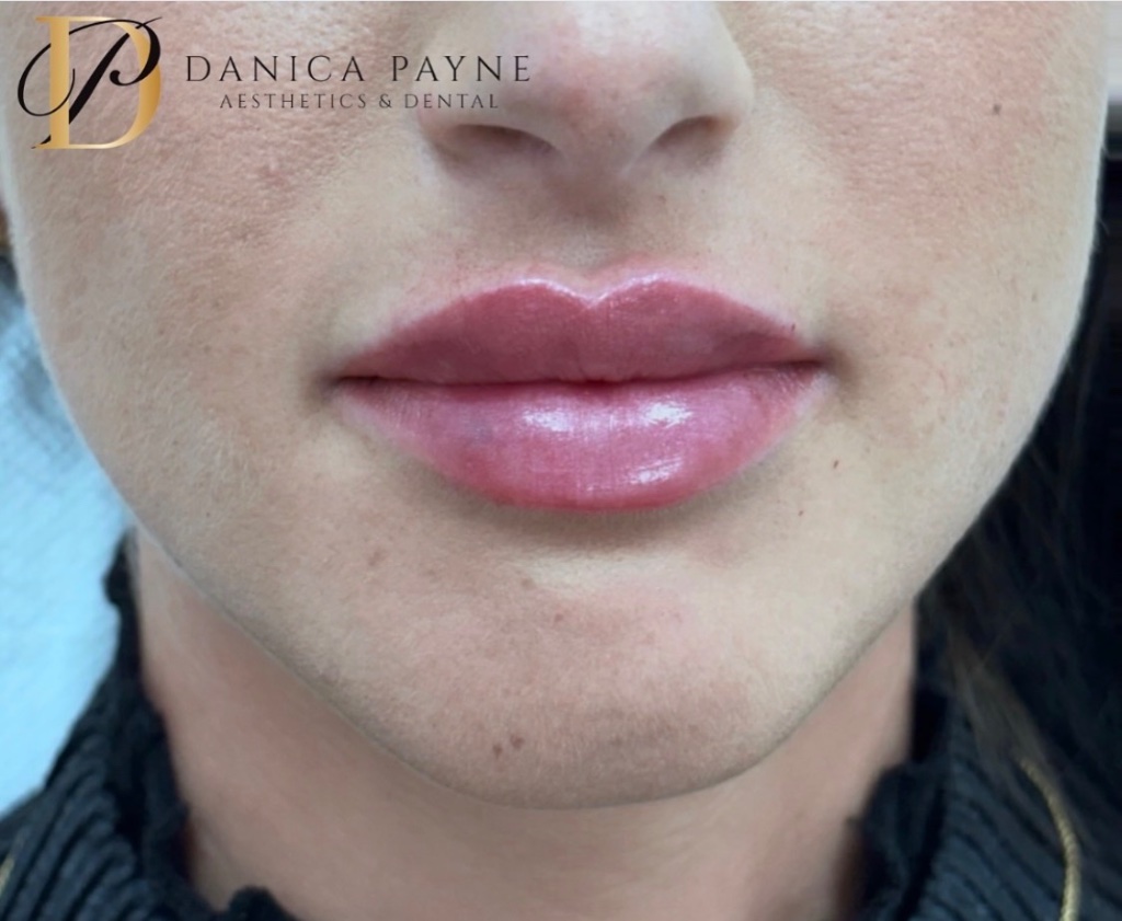 Injectables gallery 1