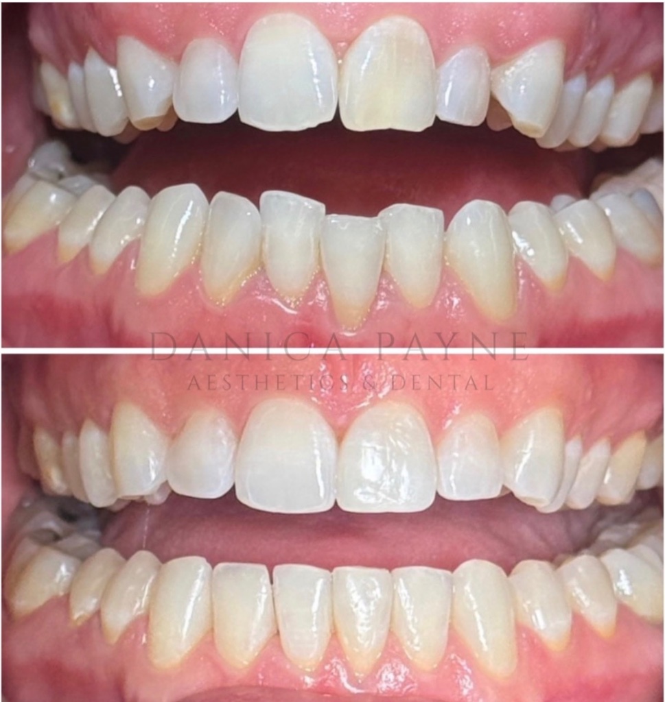 Invisalign before and after transformation 3