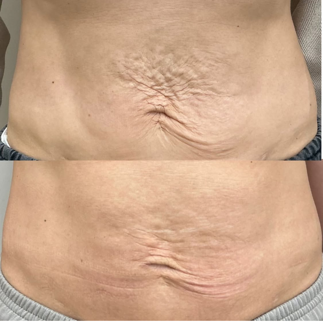 HIFU Skin Tightening — Before & After