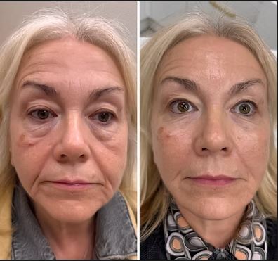 Liquid Facelift Moderate — Before & After