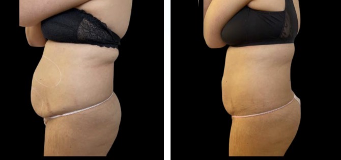 Stomach Fat Freezing (2 Sessions) — Before & After