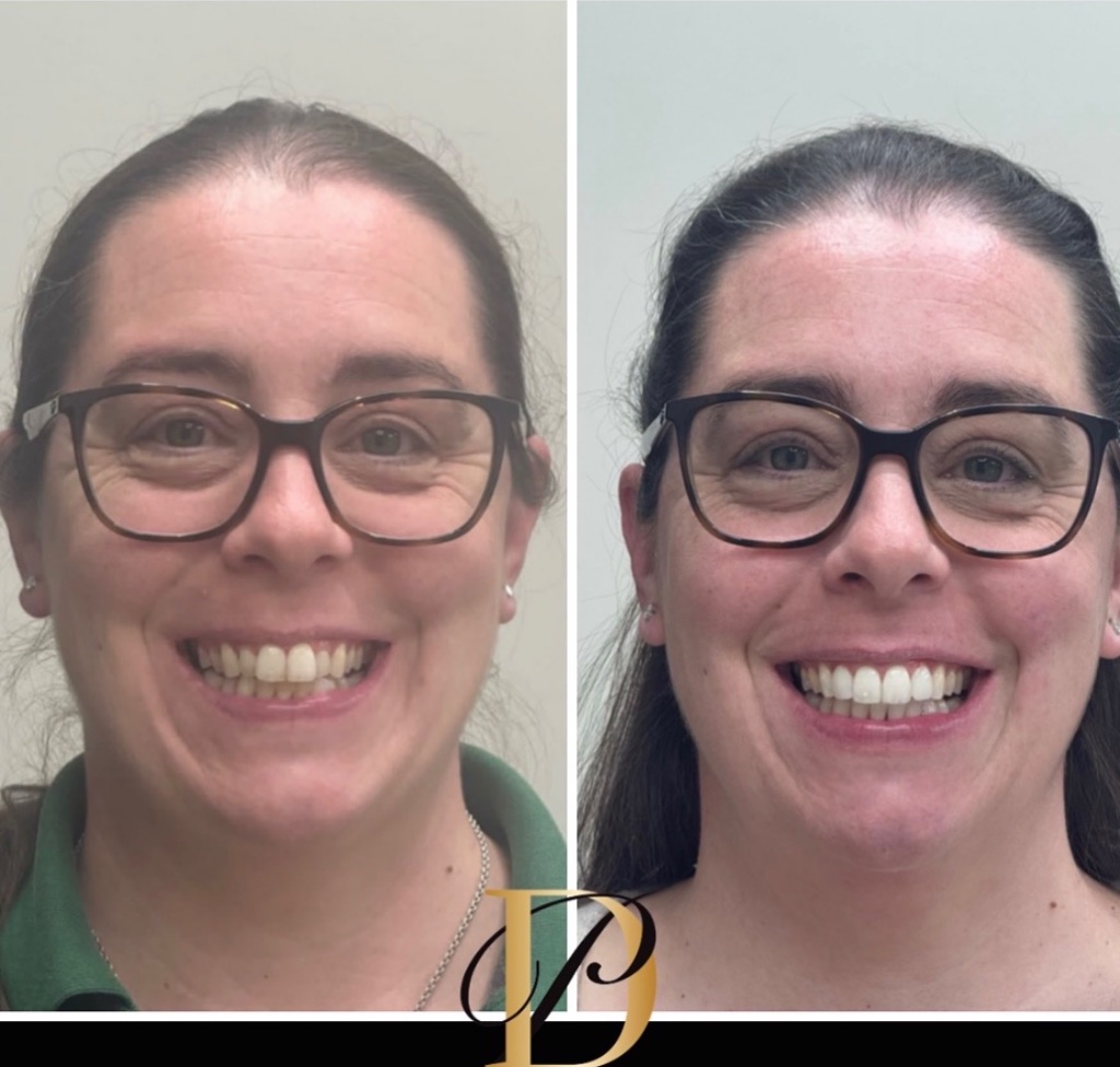 Invisalign smile transformation 2