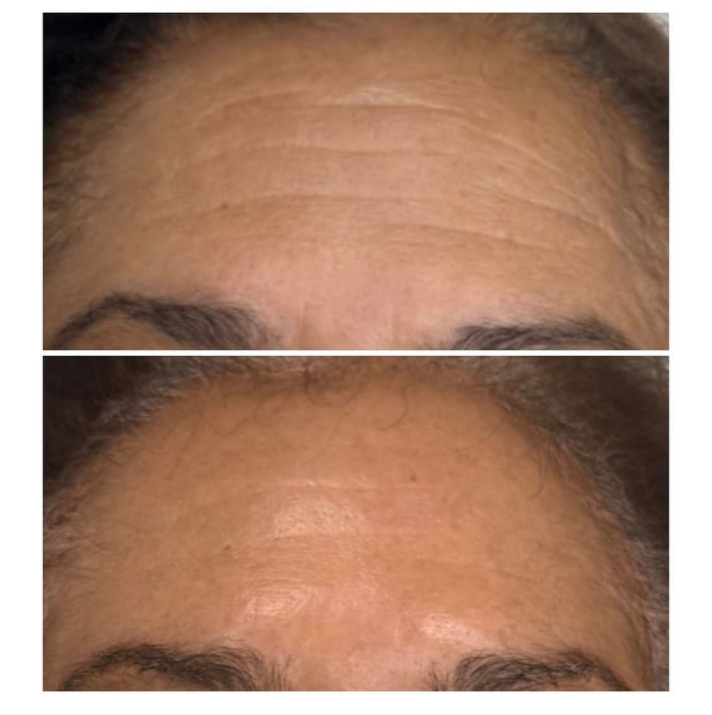 Botox Forehead — Before & After