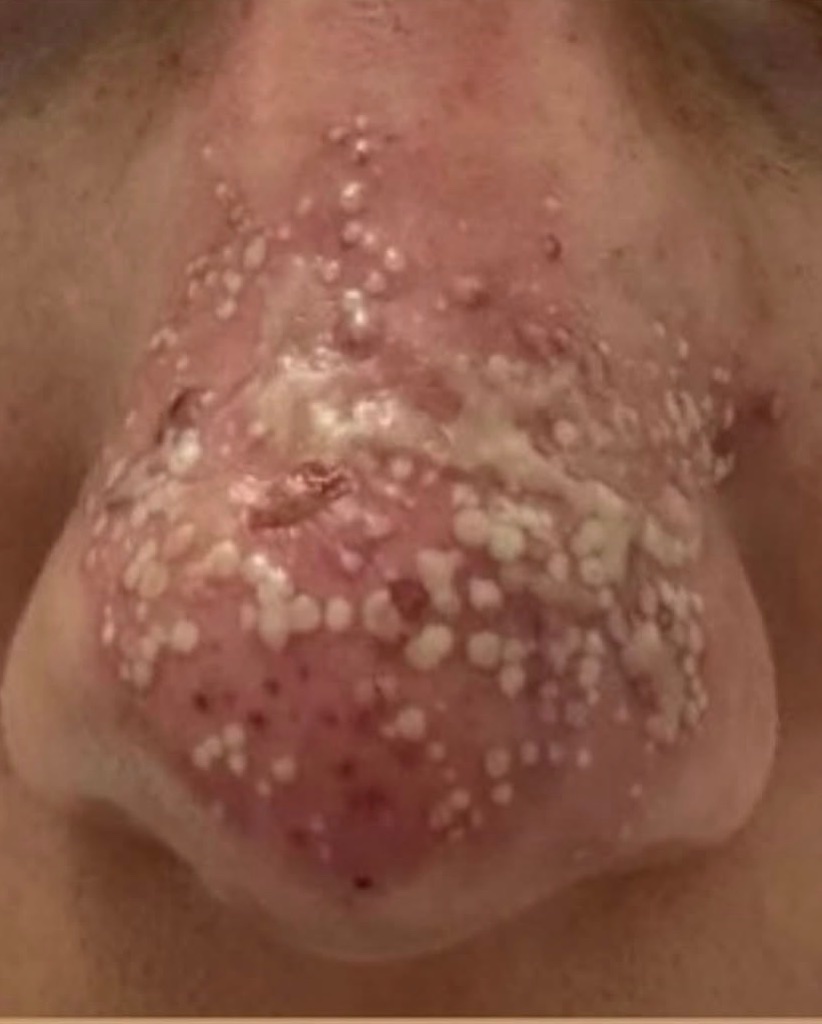 Severe Nasal Cluster — Emergency
