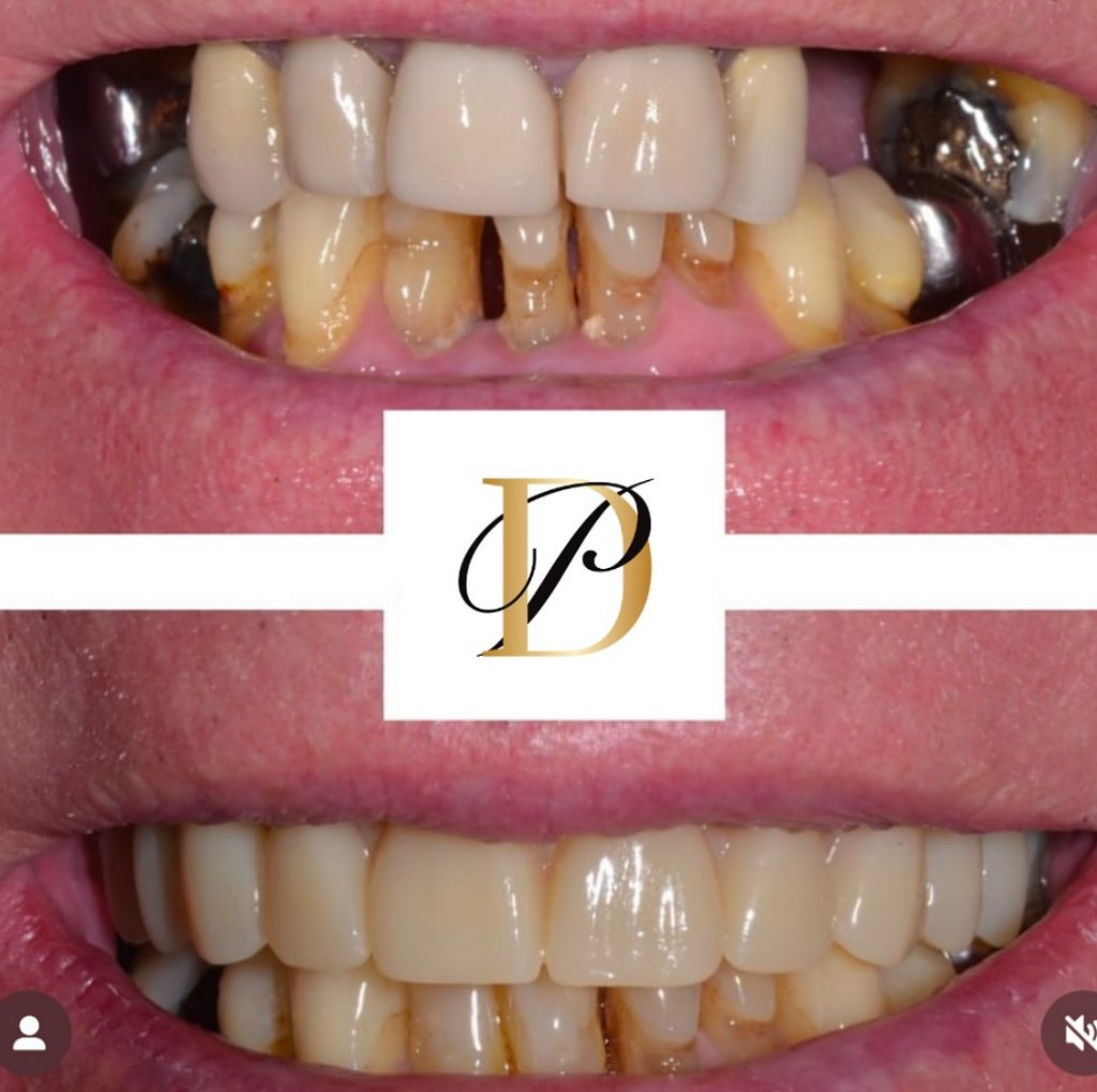 Dental Implants — Before & After