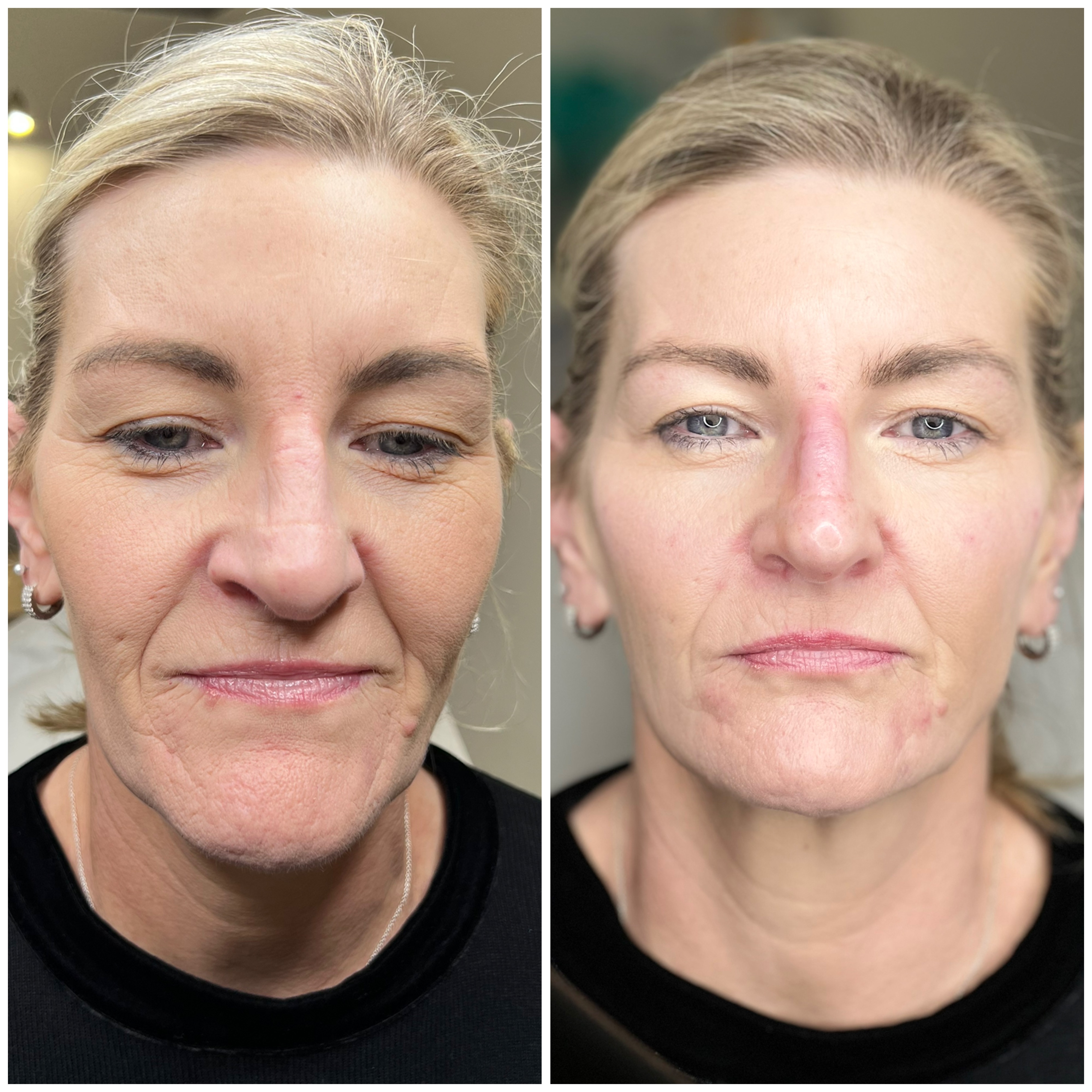 Moderate Facelift — Before & After
