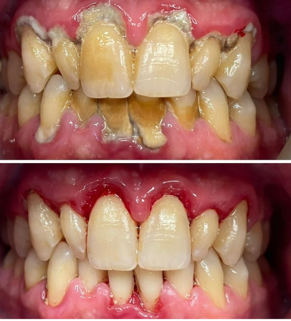 Dental Cleaning — Before & After
