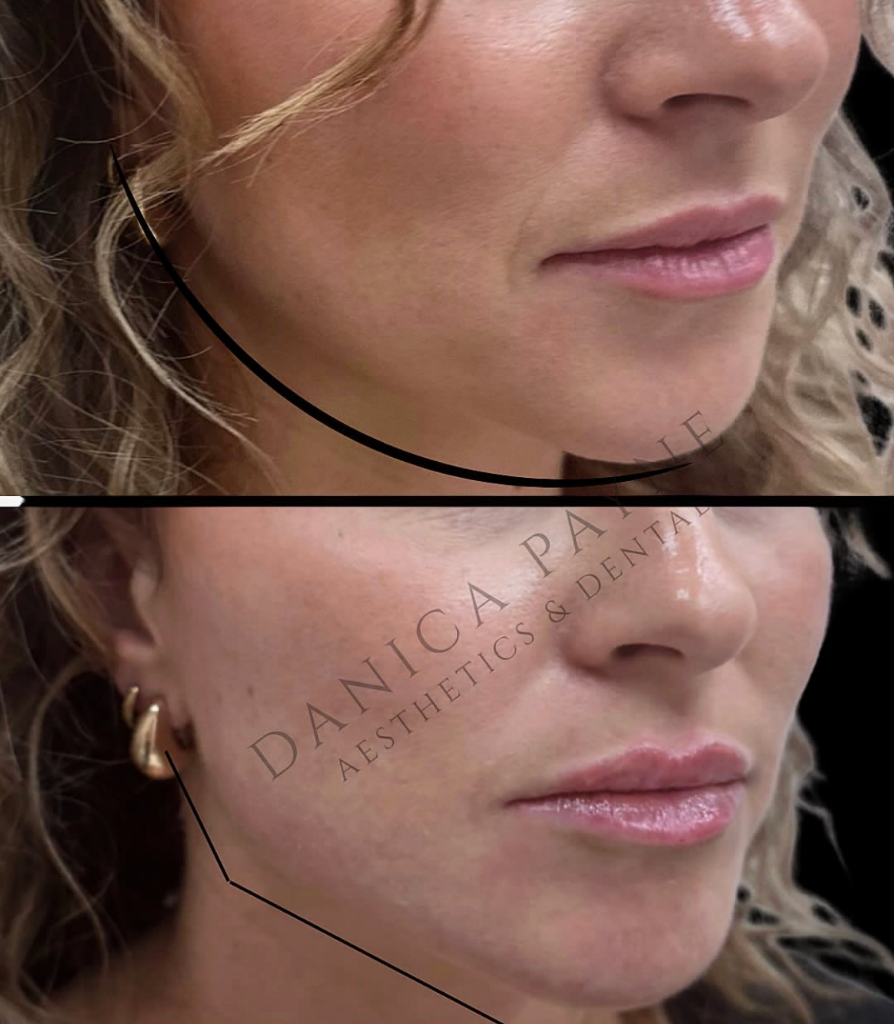 Jaw & Chin Filler Results — Before & After