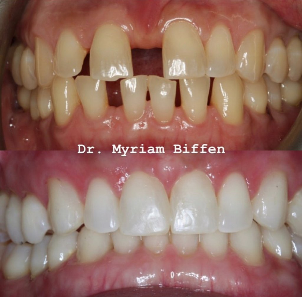 Composite Bonding by Dr Myriam Biffen — Before & After