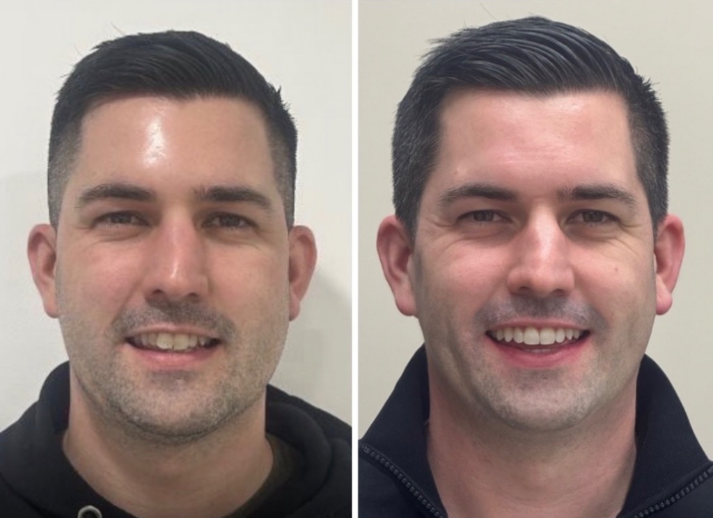 Invisalign smile transformation 4