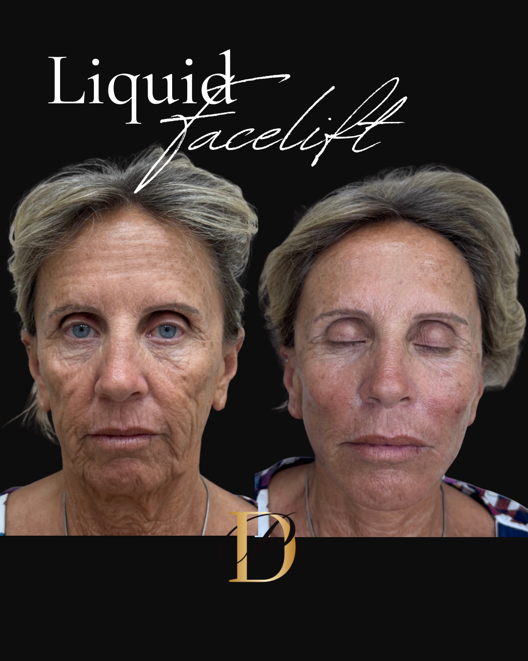 Liquid Facelift — Before & After