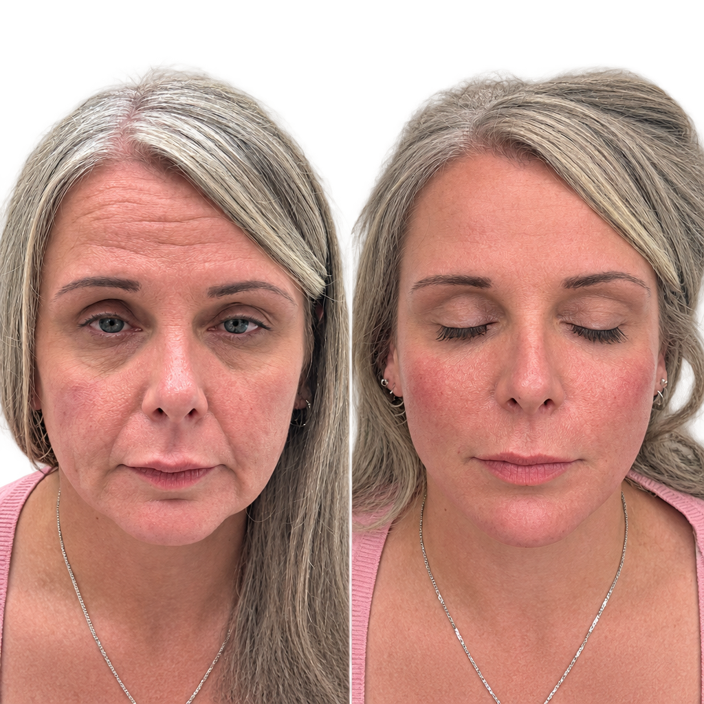 Danica Payne Full Face — Before & After