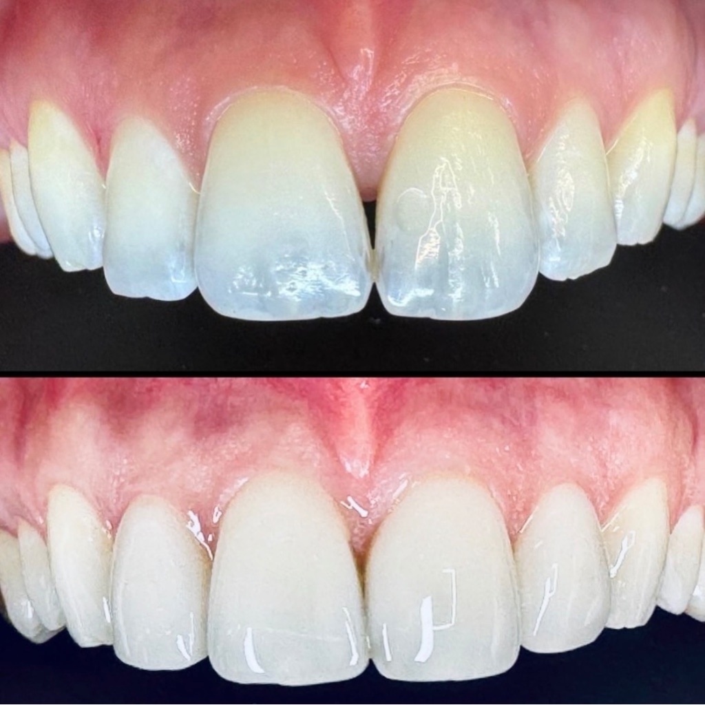 Composite bonding before and after — teeth reshaped and brightened