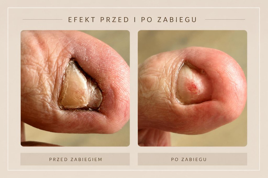 Efekt zabiegu podologicznego przed i po w gabinecie PODO MEDIC - zdjęcie 3