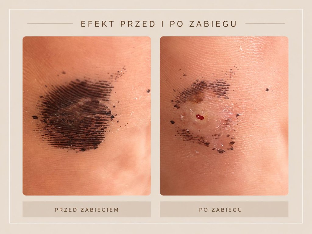Efekt zabiegu podologicznego przed i po w gabinecie PODO MEDIC - zdjęcie 2