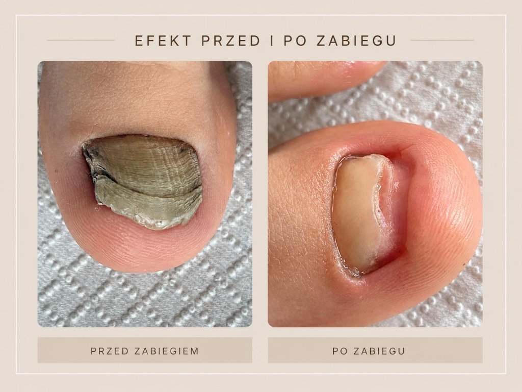 Efekt zabiegu podologicznego przed i po w gabinecie PODO MEDIC - zdjęcie 1