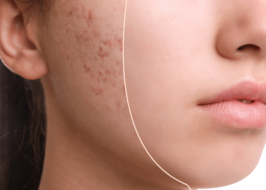 Acne Scar Treatment