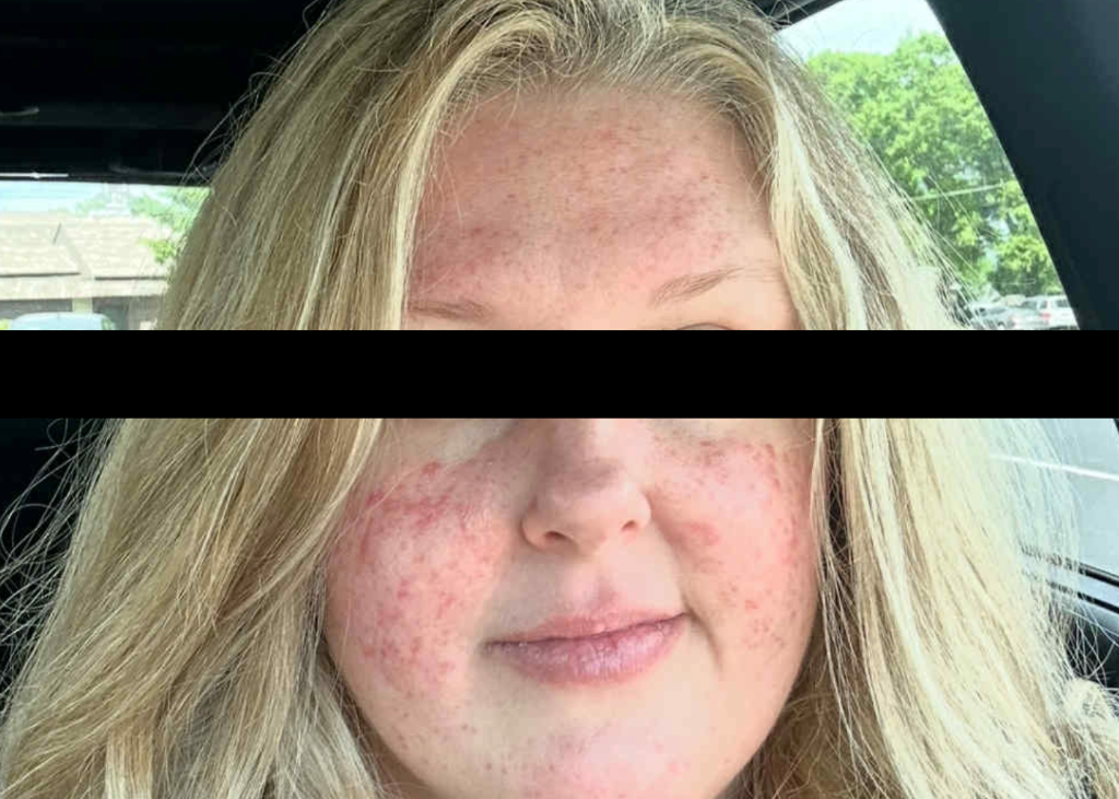 Before treatment