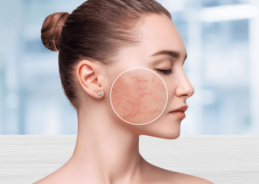 Rosacea Treatment