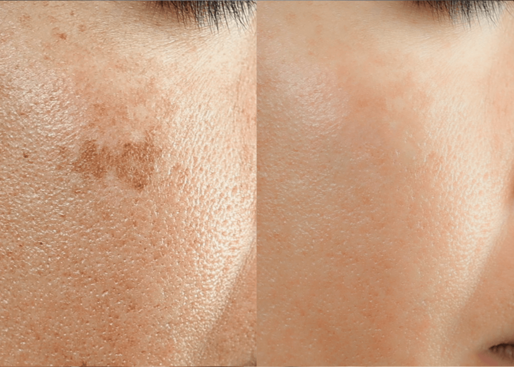 Sun Spot Removal