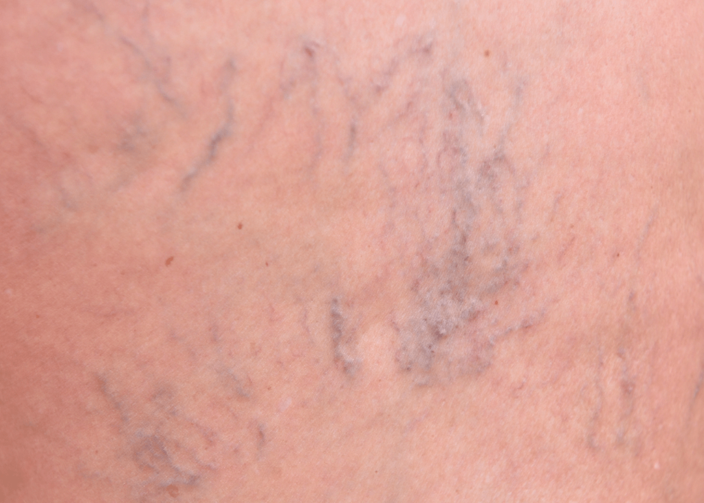 Vein Treatment
