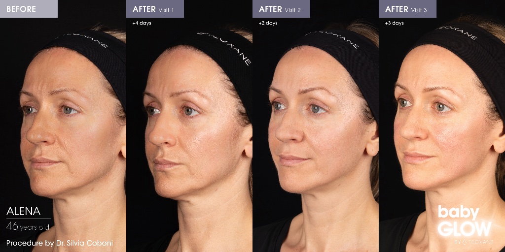 Skin Boosters before and after
