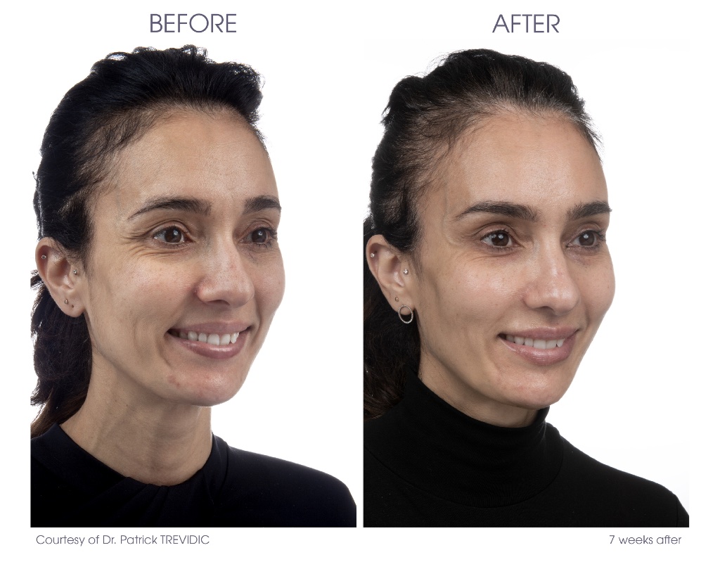 Dermal Fillers before and after