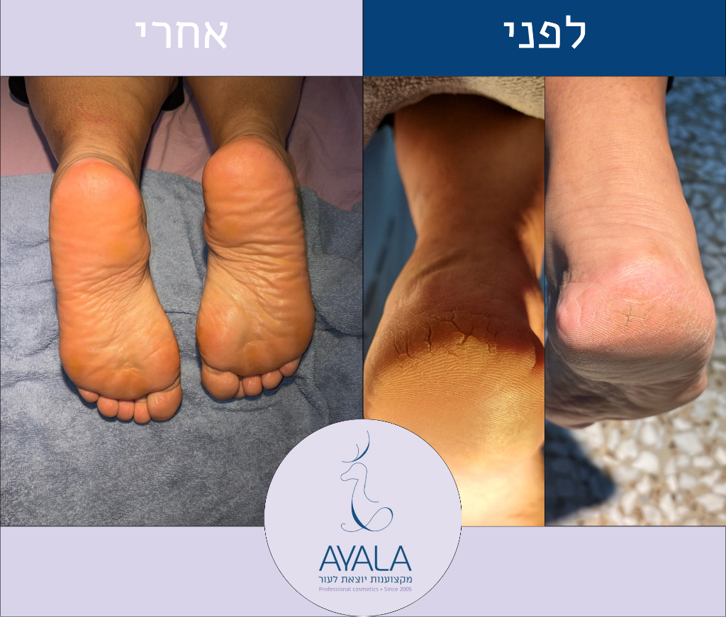 פדיקור — לפני ואחרי