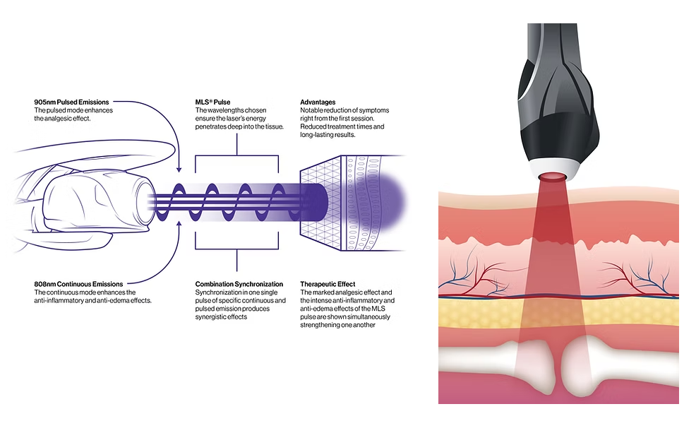MLS Laser Therapy emission mechanics and tissue penetration diagram
