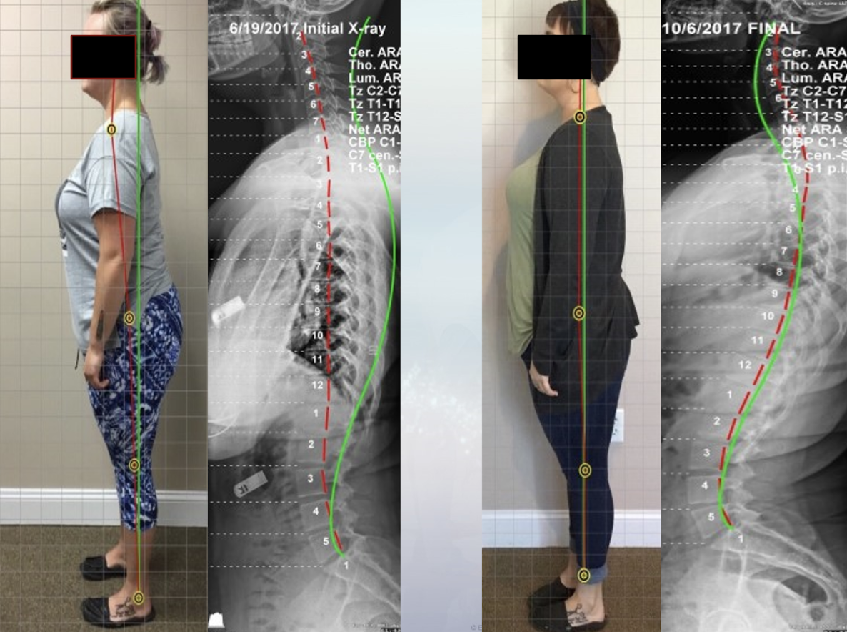 Posture Correction (CBP)