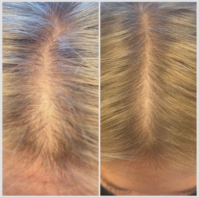 Hair restoration before and after comparison