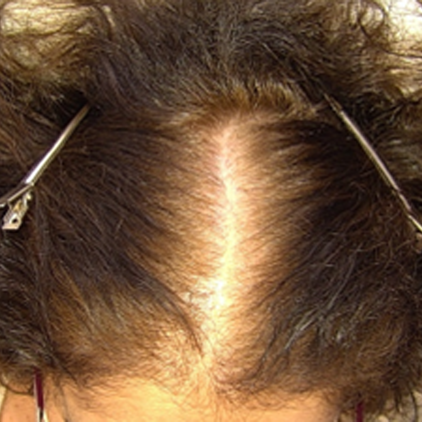 After treatment